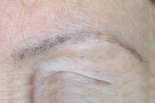 Eliminacion microblading 2