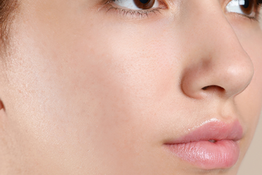 acne2 (3)