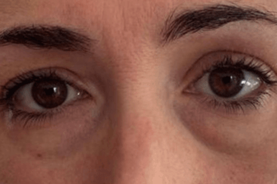 blefaroplastia 1