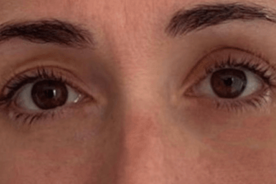 blefaroplastia 2