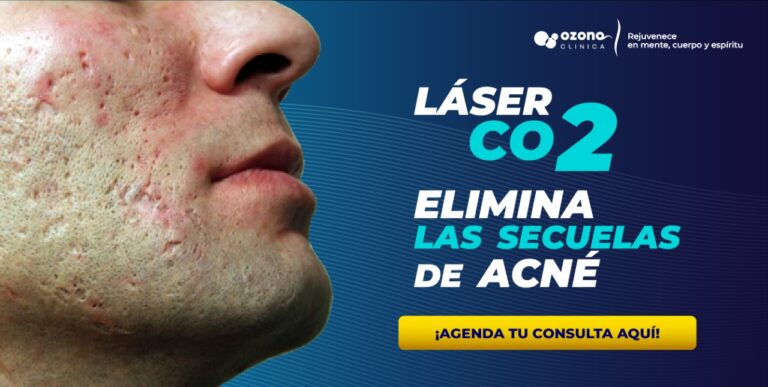 Tratamiento con láser CO2 para eliminar cicatrices de acné en rostro masculino en Ozonoclinica