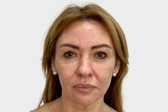 rejuvenecimento facial 1 (1)