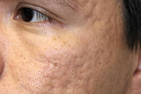 acne8