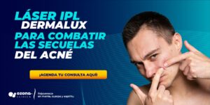 Hombre joven señalando granos en su rostro, junto a texto promocional sobre tratamiento con láser IPL para secuelas de acné