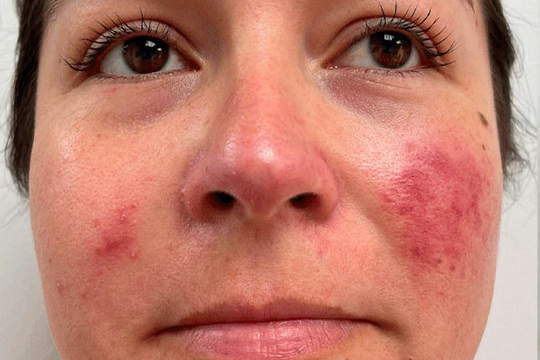 rosacea1