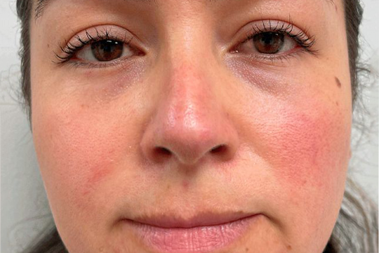 rosacea2
