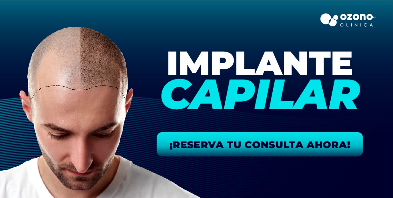 Paciente mostrando el antes y después de un implante capilar en Ozonoclinica.