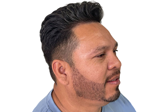 beard-hair-transplant-miami-Ebefore-after-2