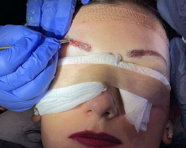 Adriana-during-the-procedure