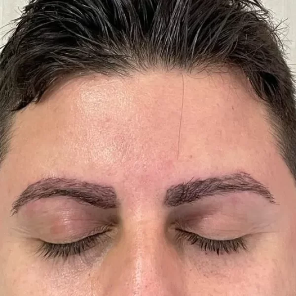 trasplante_cejas-800-s8yeyk
